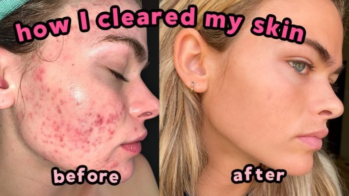 Accutane (Remove Acne) 10mg/50tabs - Apoxar 9 Accutane for acne